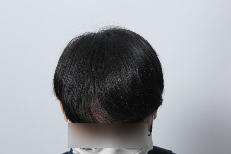 수술후 1년 3.JPG