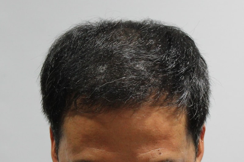 수술후 6개월 10.JPG