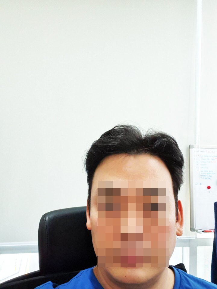 이수호 수술 후 6개월 7.jpg