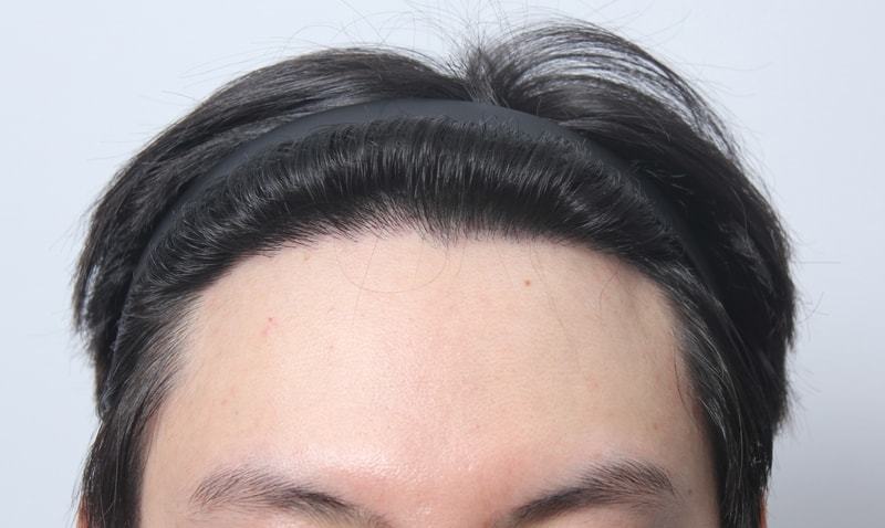 수술후 1년 26.JPG