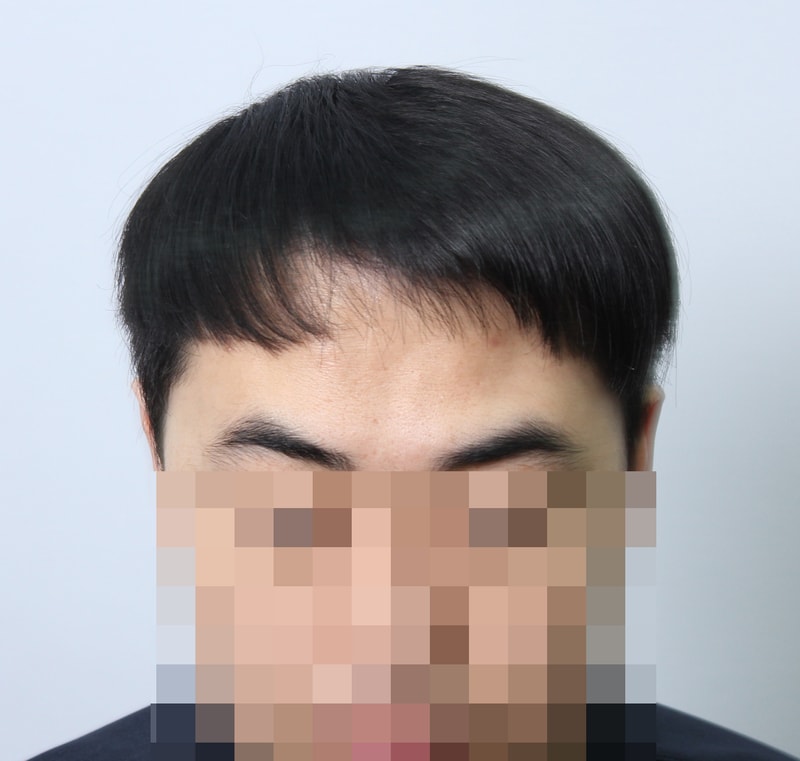 수술후 3개월 24.JPG