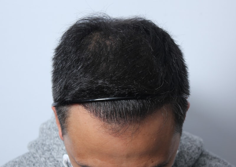 수술후 1년 27.JPG