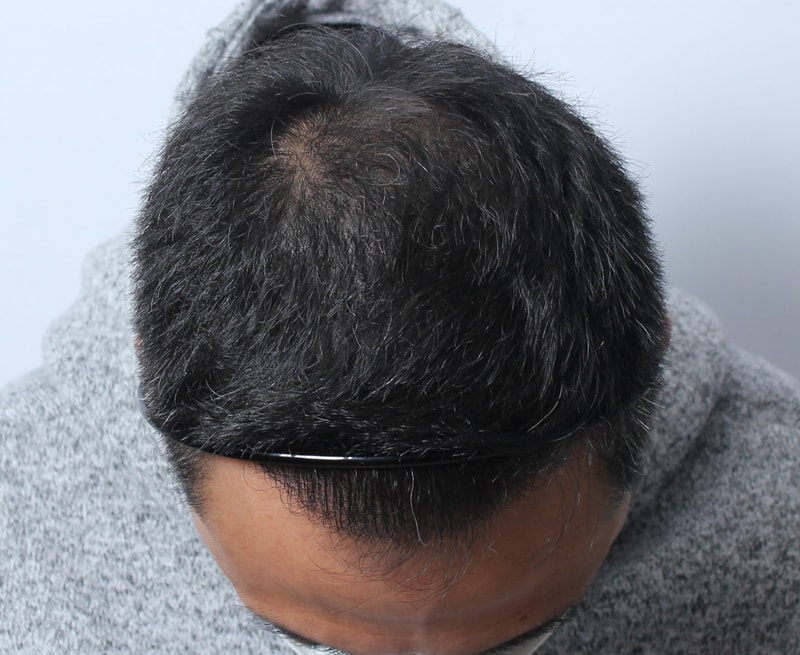수술후 1년 28.JPG
