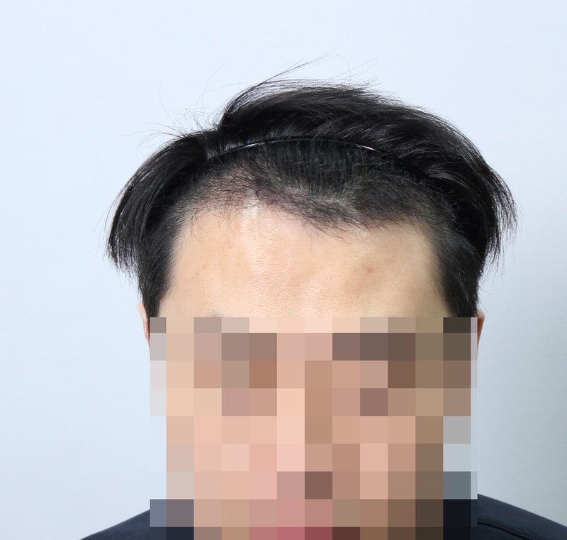 수술후 3개월 2.JPG