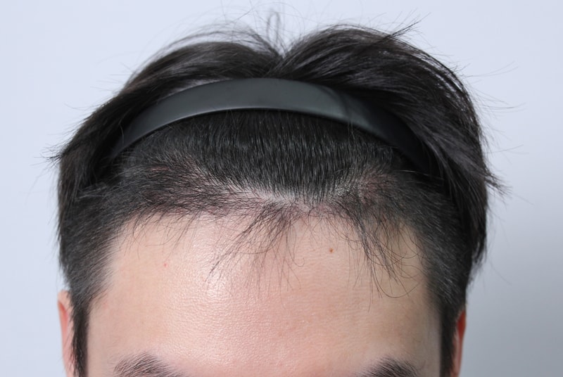 수술후 4개월 55.JPG