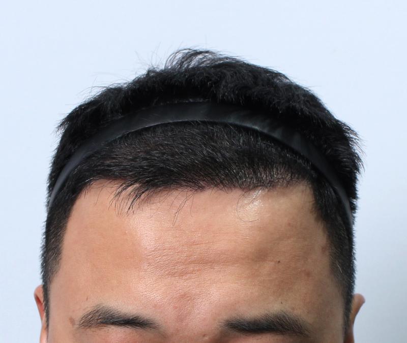 It's been 8 months since the hair transplant^^