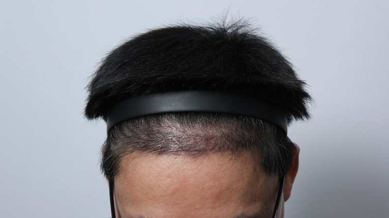 수술후4개월.JPG
