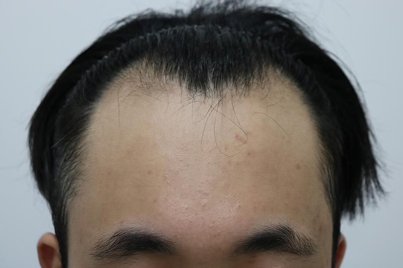3700모 수술 1년 4개월 후기
