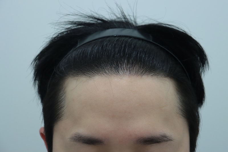 수술 후 12개월.JPG