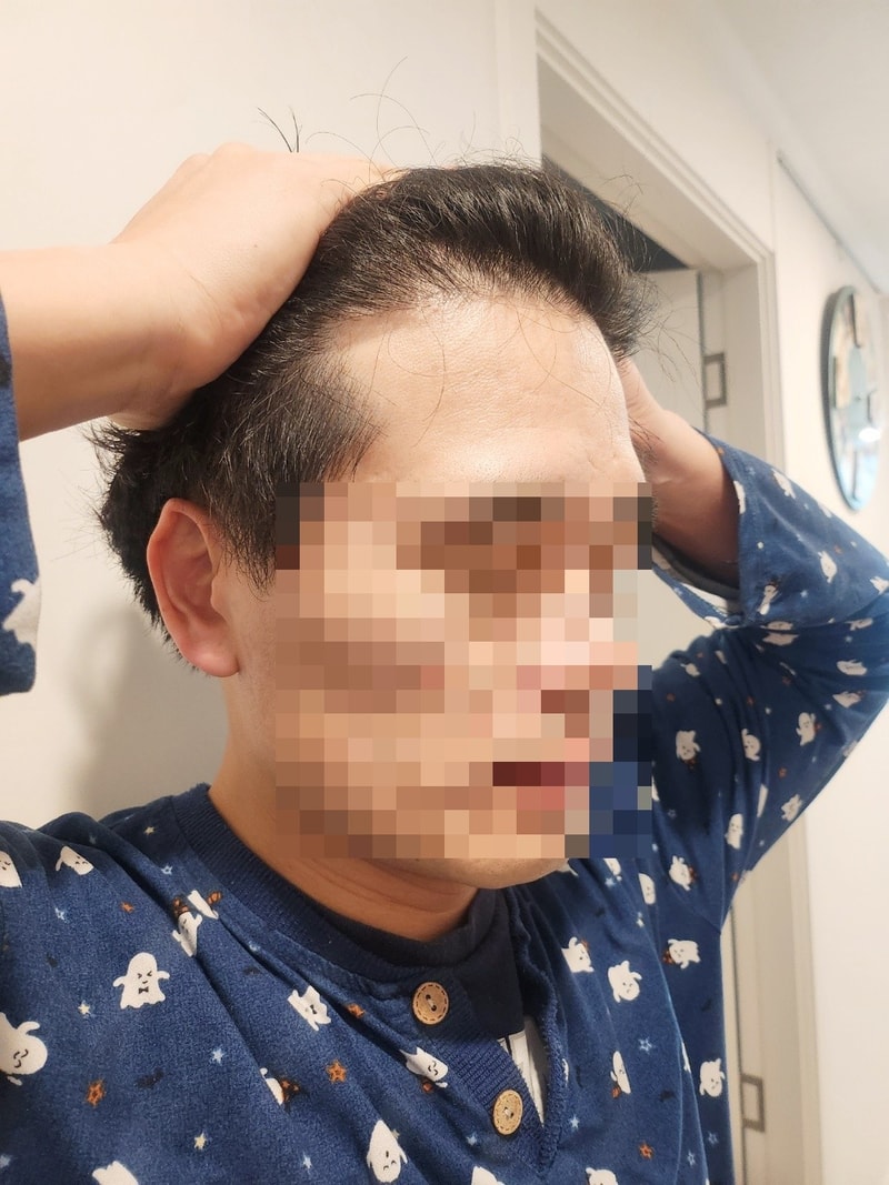 수술 후 9개월.jpg