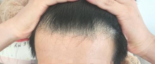 무삭발 비절개 히든컷으로 2900모! 2주 후기(뒷모습 포함)