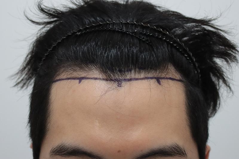 모먼트의원 모발이식 2주 후기