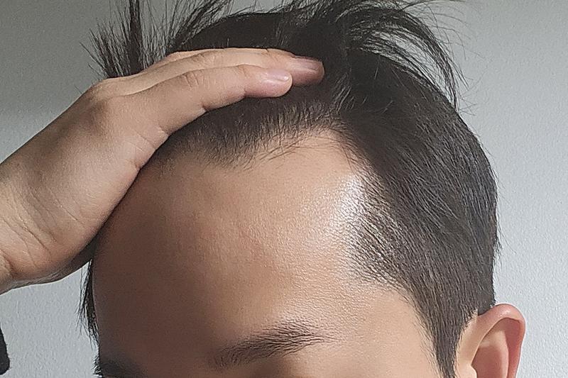 비절개 히든컷 4개월 지난 후기