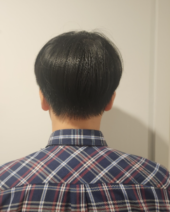 5수술 후 다음 날 뒷모습.png