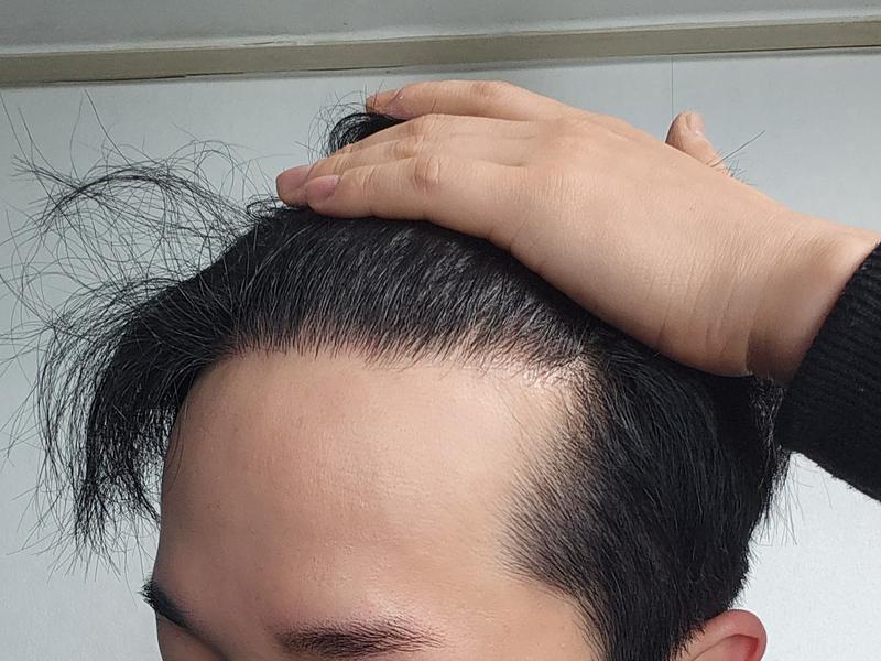 비절개 히든컷 9개월 지난 후기