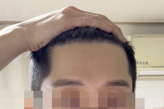 모먼트의원 무삭발 히든컷 6개월차 후기