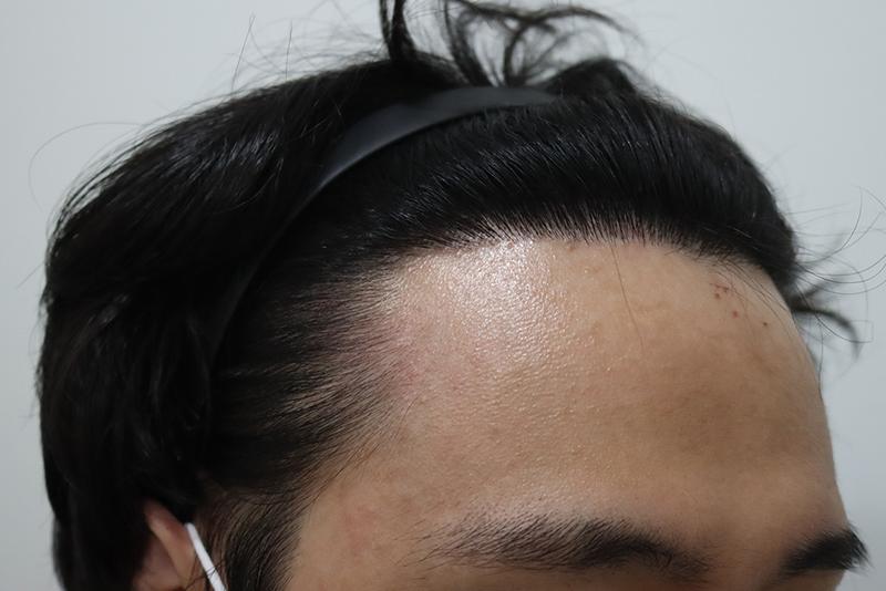비절개 히든컷 M자탈모 구레나룻 이식 9개월