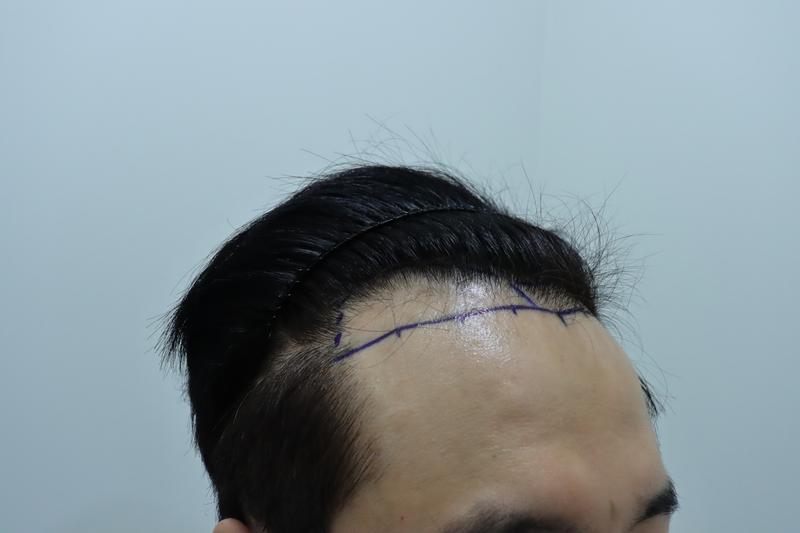 히든컷 12개월 지난 후 적는 후기