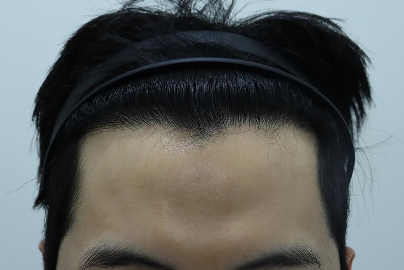 모먼트의원 모발이식 1년 후기