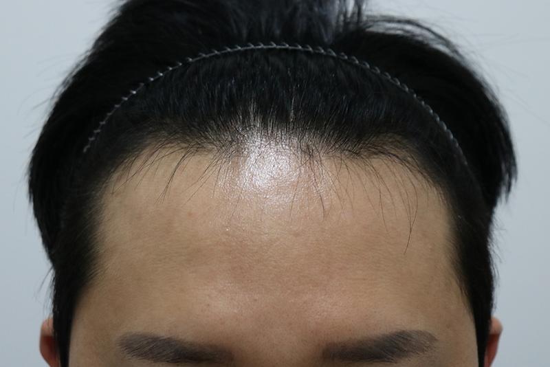 2,400 hair cut hidden cut 2 weeks later