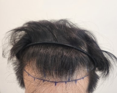3수술 전 디자인.jpg