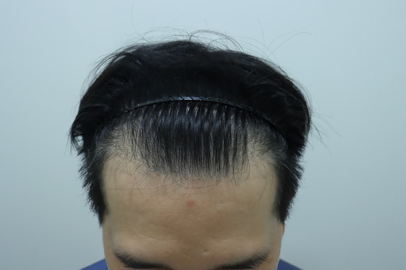 수술 전.JPG