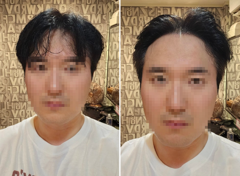 수술 후 17개월.. 비절개 히든컷 리얼 후기
