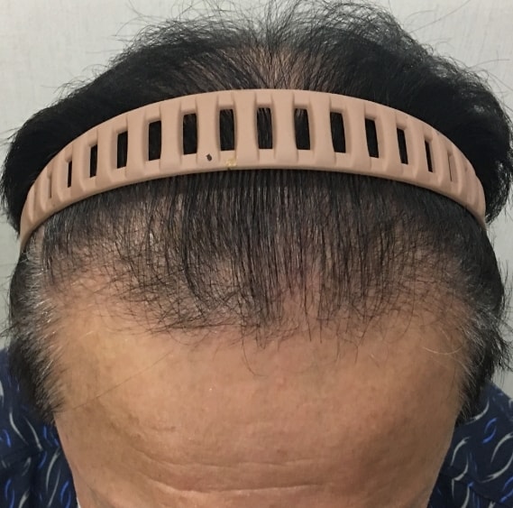 정수리 헤어라인 모발이식