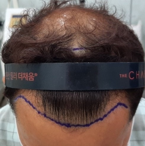 1.수술전1.jpg