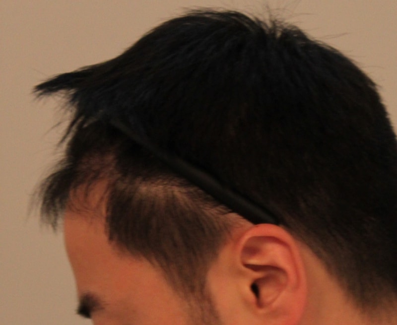 我看了6个月的Four Hair非切开手术