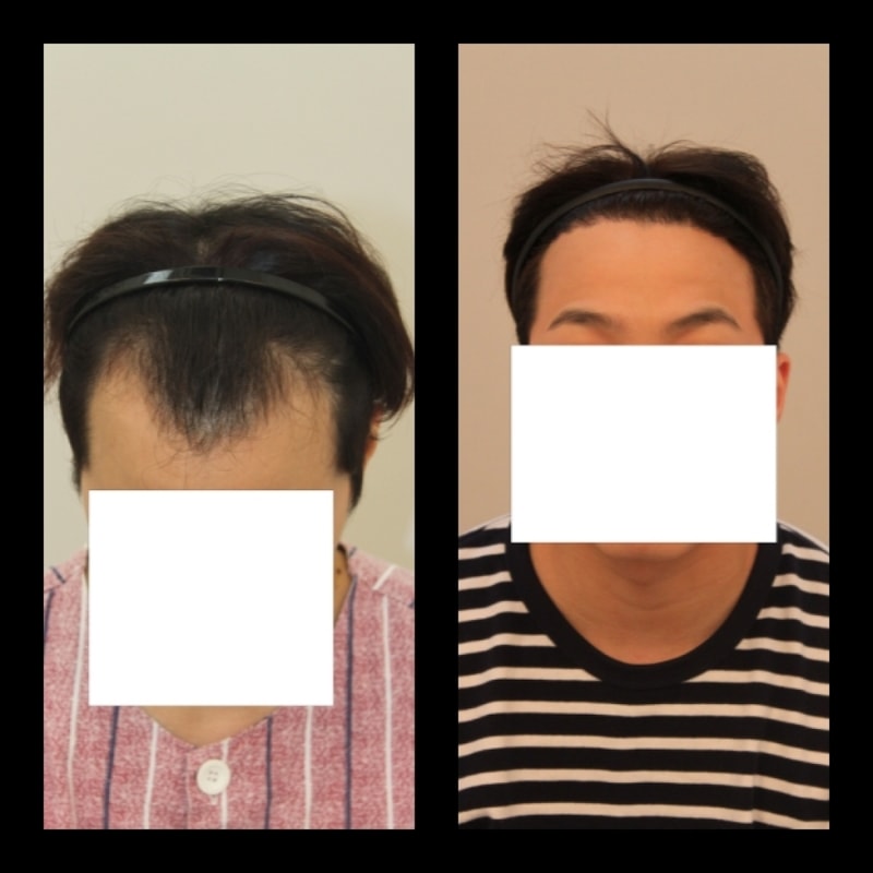 포헤어 1400모낭 자라는중 입니다. 얼른얼른 더 머리가 자랐으면 좋겠어