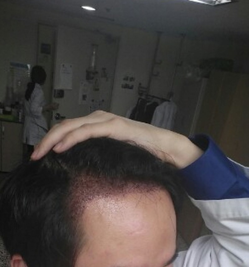 ラインを下げてから10ヶ月が過ぎたレビュー
