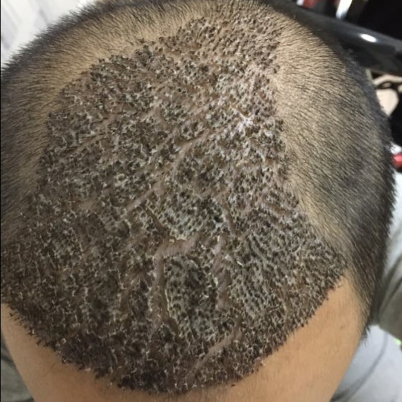 在动作中，醉中生青年移植3000毛囊后自行摘除痂皮