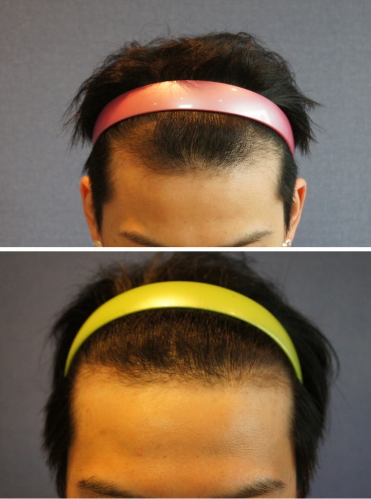 Motion!!! It's been a year since the non-cutaneous 800 hair follicle