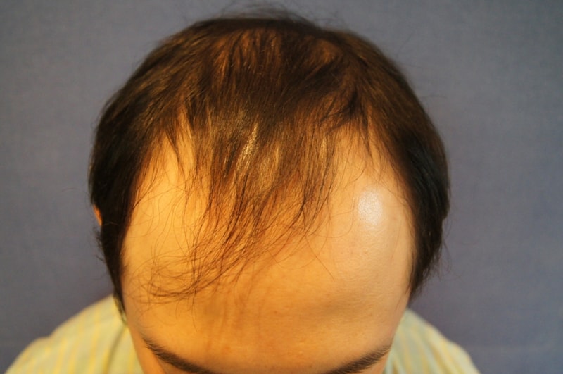 モーションで1600毛包ヘアライン手術から2ヶ月経過した写真です