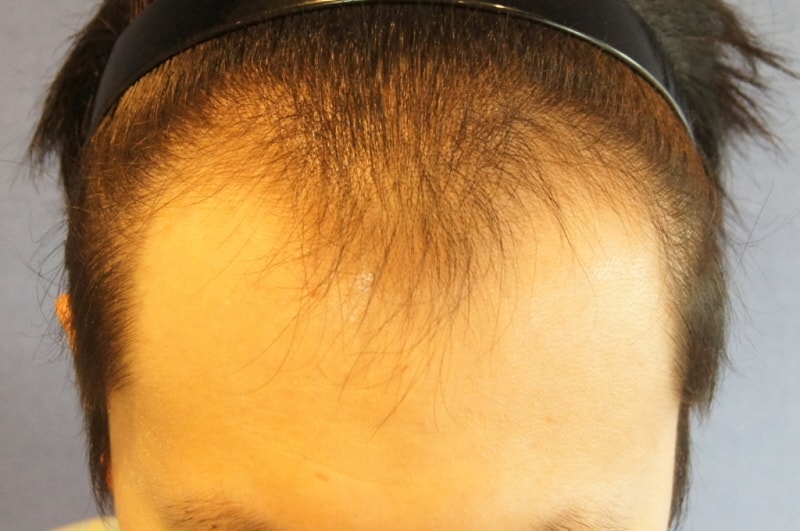 Motion hair transplant clinic 1400 hair follicles 8 months later