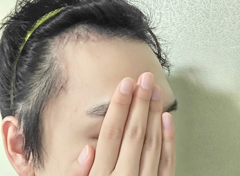 モーション1300毛包手術から2ヶ月が経過、まだ暗黒期..