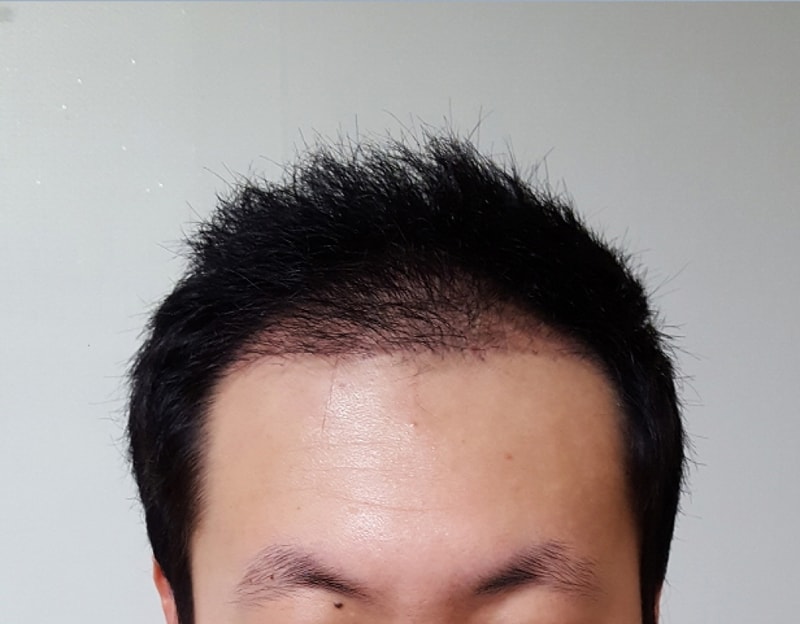 Motion hair transplant clinic 1400 hair follicles 4 months later