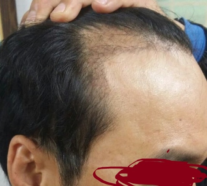 모션 1400모낭 비절개 모발이식 수술 6개월 경과입니다