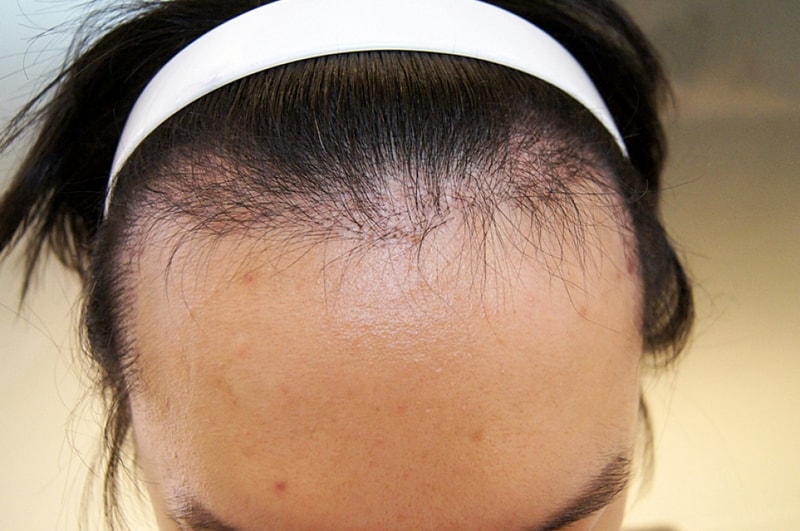 モーション1300毛包手術から4ヶ月が経過し、さらにひどくなった暗黒期..
