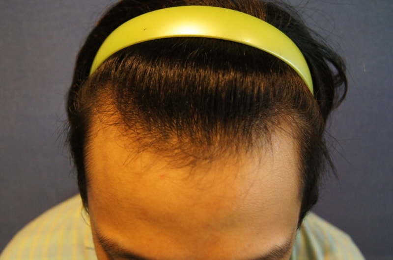 3 months after motion 1200 follicle hair transplantation