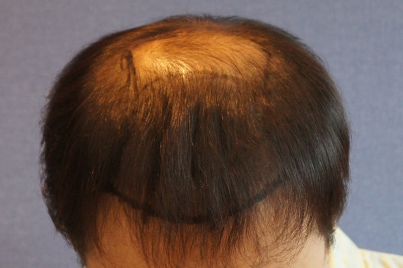 Motion 2800 Hair follicle hairline + 10 months of upper limb hair transplantation