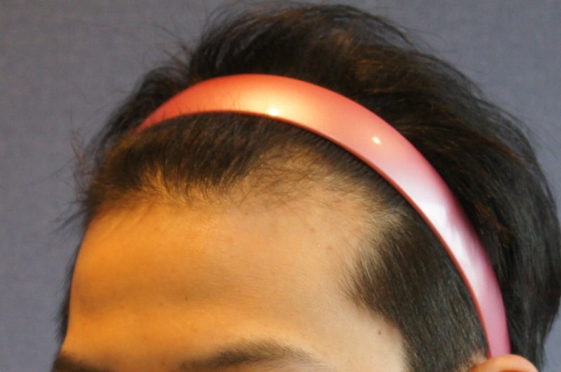 This is a picture of a year and five months after the motion non-incisionless 800 hair follicle transplant