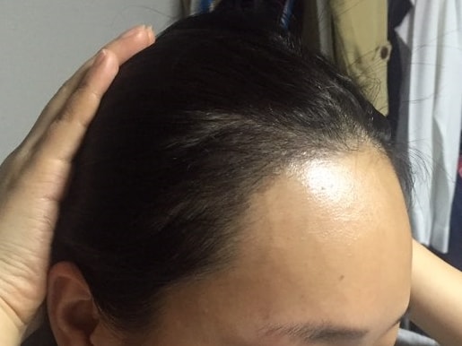 モーションでヘアライン600毛包移植を受けて100日目の写真をアップします~