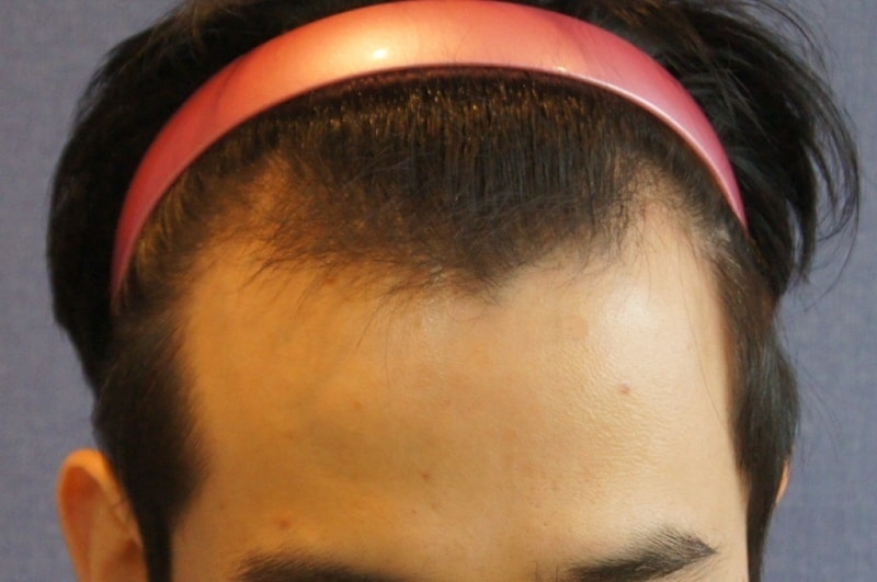 Motion 1200 follicle nasal incision for 3 months