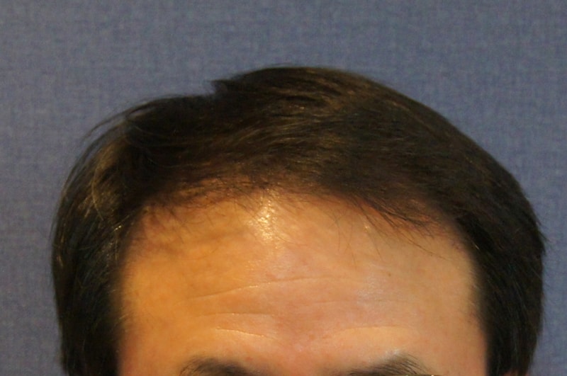 Motion Mza 1000 hair follicles (2000 hair) It's been 5 months of hair transplantation