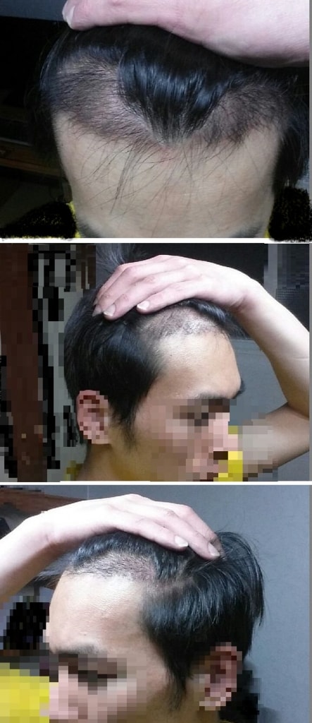 上传动作M字1200毛囊非切开剃头100天后记呵呵