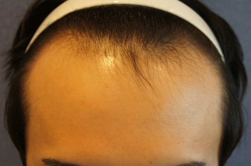 It's been 6 months since the 1400 hair follicle incision was made in motion