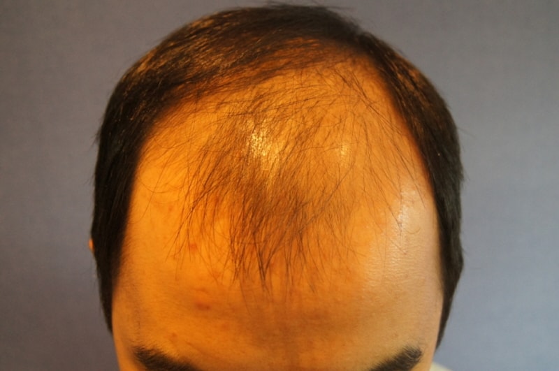 In Motion, after 9 months of 2000 follicle non-excision on the weekend