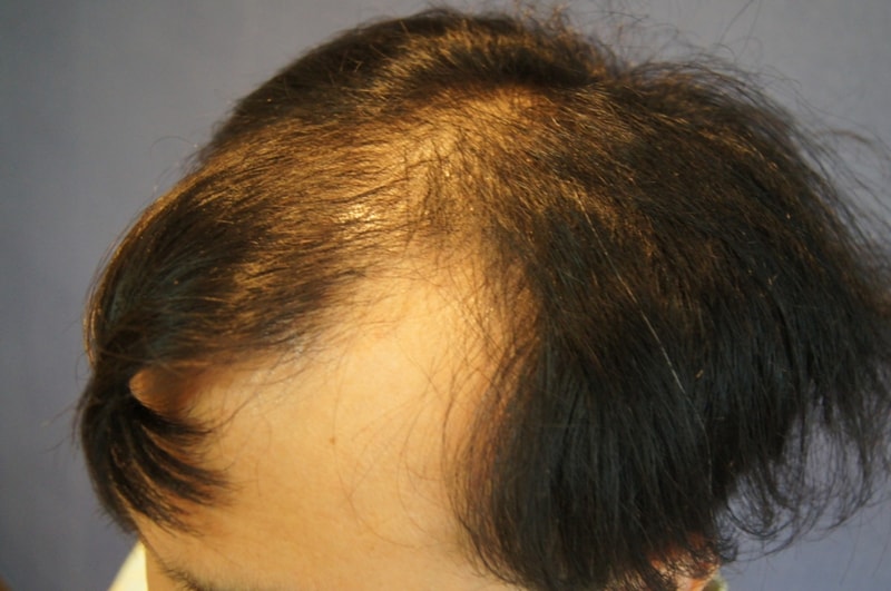 Motion 1600 Hair follicle 10 months after hair transplantation